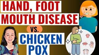 Hand Foot Mouth Disease VS Chicken Pox. Ano ang Sakit? - By Doc Liza Ramoso-Ong