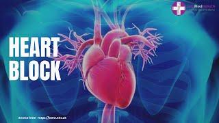 Heart Block  Cardiac Rhythm