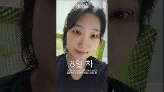 눈절개 + 앞트임 재수술 후기