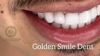 Veneers in Turkey @GoldenSmileDent