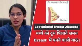 What is Breast Abscess I Lactational Breast Abscess