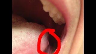 2 Main Reasons of Bumps on Back of Tongue