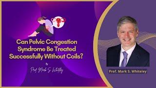 Can Pelvic Congestion Syndrome Be Treated Successfully Without Coils ? By Prof  Mark Whiteley