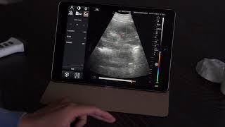 DW-X1 Clinical video of the Wireless Color Doppler Convex linear array dual head probe part 2