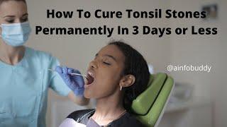 How To Cure Tonsil Stones Permanently In 3 Days or Less