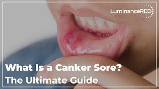 What Is a Canker Sore? The Ultimate Guide