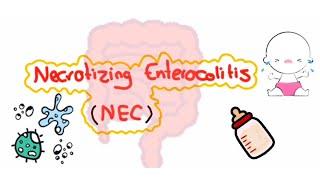 Necrotizing enterocolitis NEC