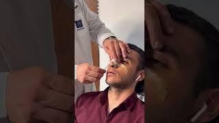 برداشتن گچ بینی یک هفته بعد از عمل  Removing Nose external Splint one week after surgery