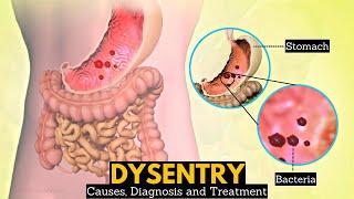 What is Dysentery? Causes Signs and symptoms Diagnosis and treatment.