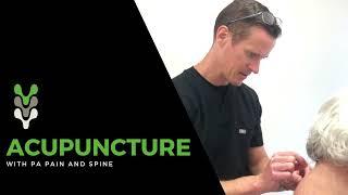 Acupuncture with PA Pain and Spine