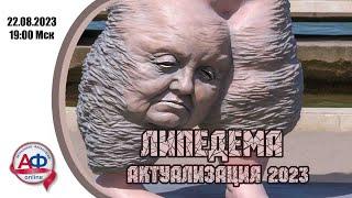 Липедема 2023