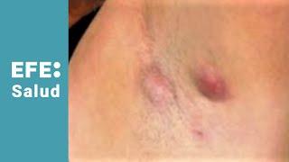 Hidradenitis supurativa abscesos en la piel y mal olor