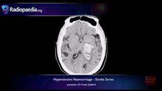 Stroke Hypertensive haemorrhage - radiology video tutorial MRI CT