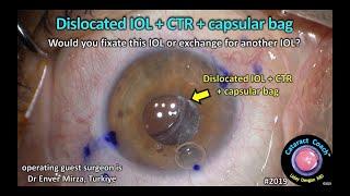 CataractCoach™ 2019 dislocated IOL & CTR & capsular bag