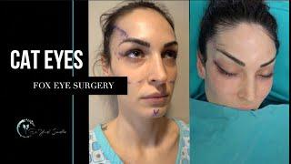 CAT EYE OR FOX EYE SURGERY  BY OP. DR. YUCEL SARIALTIN