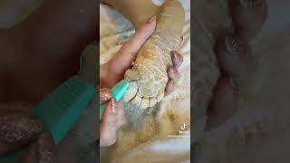 Full foot callus removal - Epidermolytic Palmoplantar Keratoderma - Jan 30 2023