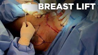 BREAST LIFT SURGERY