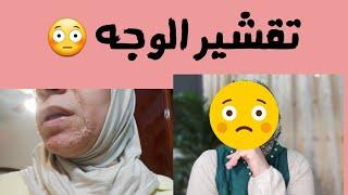 تقشير بارد للوجه قبل وبعدالتقشير البارد للوجه