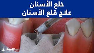 قلع الأسنان – علاج  “socket preservation” ©