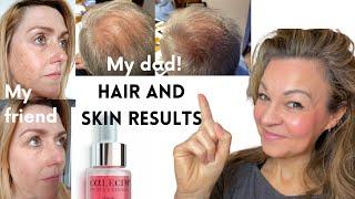 My 79-yr-old Dads Surprise Hair Growth Results with Calecim Professional