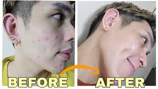 WORST ACNE BREAKOUT PAANO ANG GINAWA KONG TREATMENT? SIR LAWRENCE