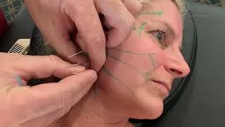 Bells Palsy Nerve Acupuncture Stimulation