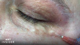 Carboxytherapy Helps Treat Dark Under-Eyes