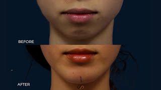 Chin Implant Surgery  Before and After  Dr. David Stoker