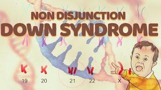 Nondisjunction Down Syndrome  Chromosome 21  Trisomy