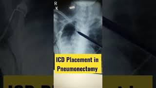Comments the upper lobe ICD purpose ? #ICD #Chestdrainage #Pneumonectomy #Lung #surgery #shorts
