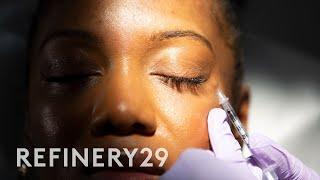 I Got Botox Injections for the First Time  Macro Beauty  Refinery29