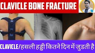 COLLARCLAVICLE BONE FRACTURECLAVICLE BONE टूट जाने पर क्या करेंBONE FRACTURE X RAYX RAY कैसे करे