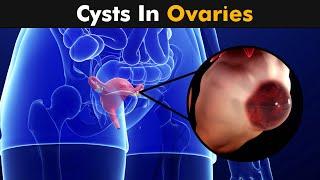 Ovarian Cysts  Types Causes and Symptoms UrduHindi