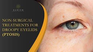 Non-Surgical Treatments For Droopy Eyelids Ptosis  Radium Medical Aesthetics