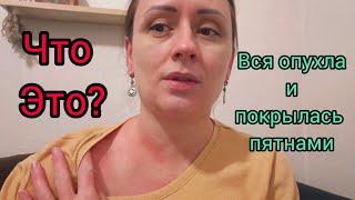 Всё тело в пятнах Что со мной?