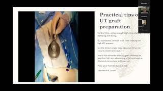 To the wonderland - Endothelial keratoplasty tips and tricks - Dr Nancy Al Rakkad