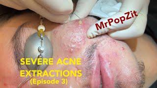 Severe Acne Extractions episode 3. The final episode part 3 of 3. Giant waxy plugs removed.