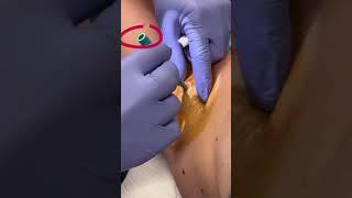 High pressure abscess POPPED  208SkinDoc