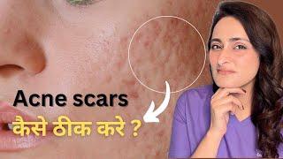 Acne Scar  kaise hataye  Laser Derma roller  hindi  Tvacha ke doctor