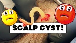 SCALP CYST