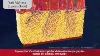 Liposuction Yağ Aldırma Ameliyatı Videosu Bursa