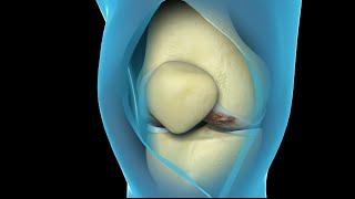 Total Knee Replacement Surgery  Nucleus Health