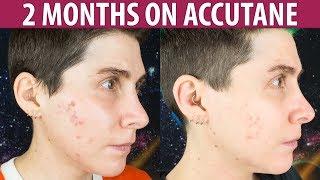 Accutane for Persistent Mild Acne — 2 Month Update