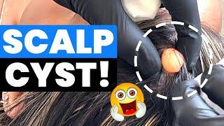 SCALP CYST