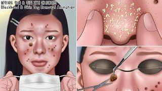 ASMR sebum explosion Care for sensitive skin in a mask  Blackhead & skin wart removal animation