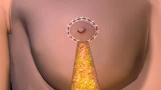 How Breast Lift Works Animation -  Breast Reduction Procedure Video