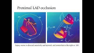 Localizing the #culprit #artery #blockage in patients experiencing a #STEMI #ECG analysis - #MI