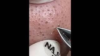 ASMR Satisfying extreme Blackhead Removal Animation Blackhead Extrusion on nose  Skincare at home