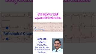 Old inferior wall myocardial infarction
