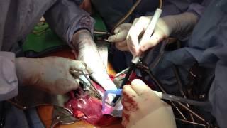 Bloodless Medicine and Surgery Liver Resection